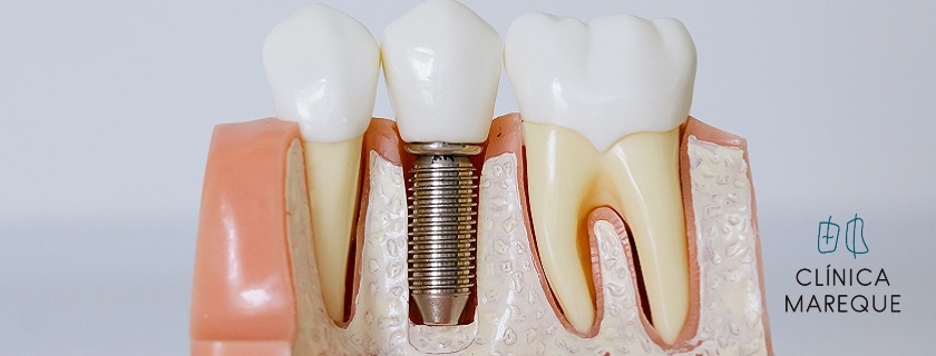 implantes dentales en Pontevedra Marisol Mareque