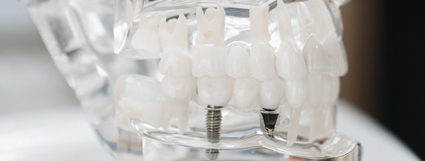 implantes dentales Pontevedra