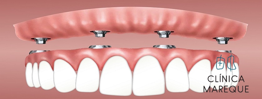 Implantes dentales en Pontevedra