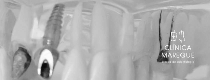 Implantes dentales Pontevedra
