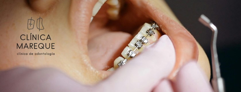 Ortodoncia en adultos en Pontevedra